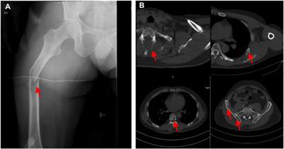 Case Report: Gene Heterogeneity in the Recurrent and Metastatic Lesions of a Myxoid Chondrosarcoma Patient With Aggressive Transformation